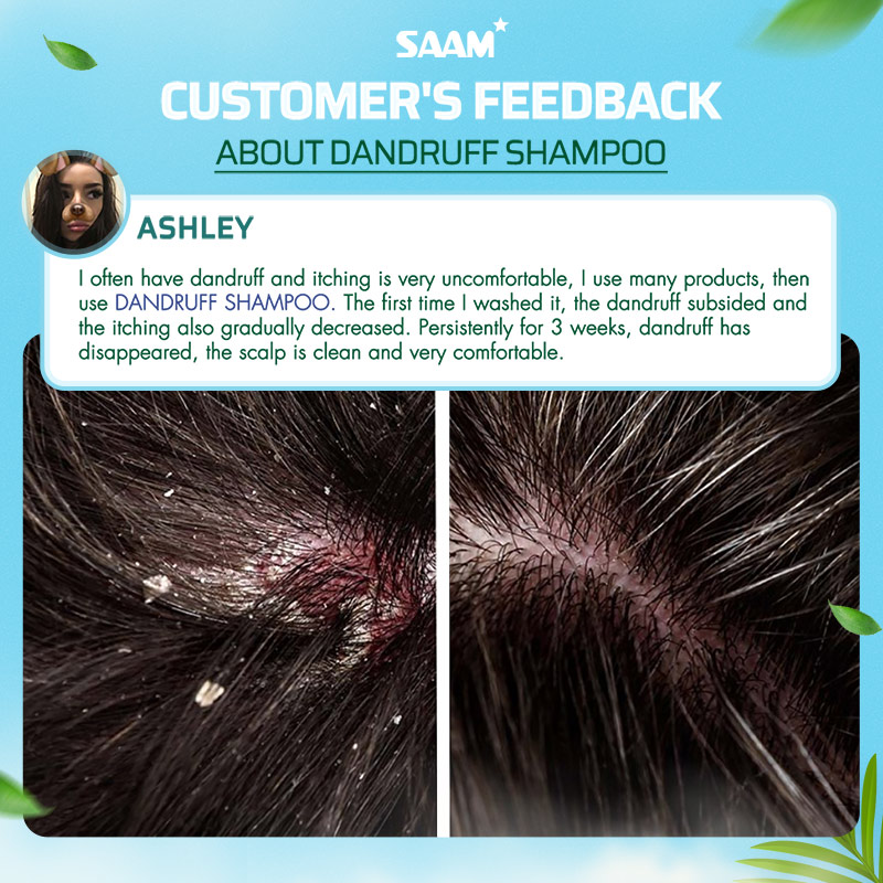 Real feedback from SAAM customer after using Dandruff Shampoo for 3 weeks