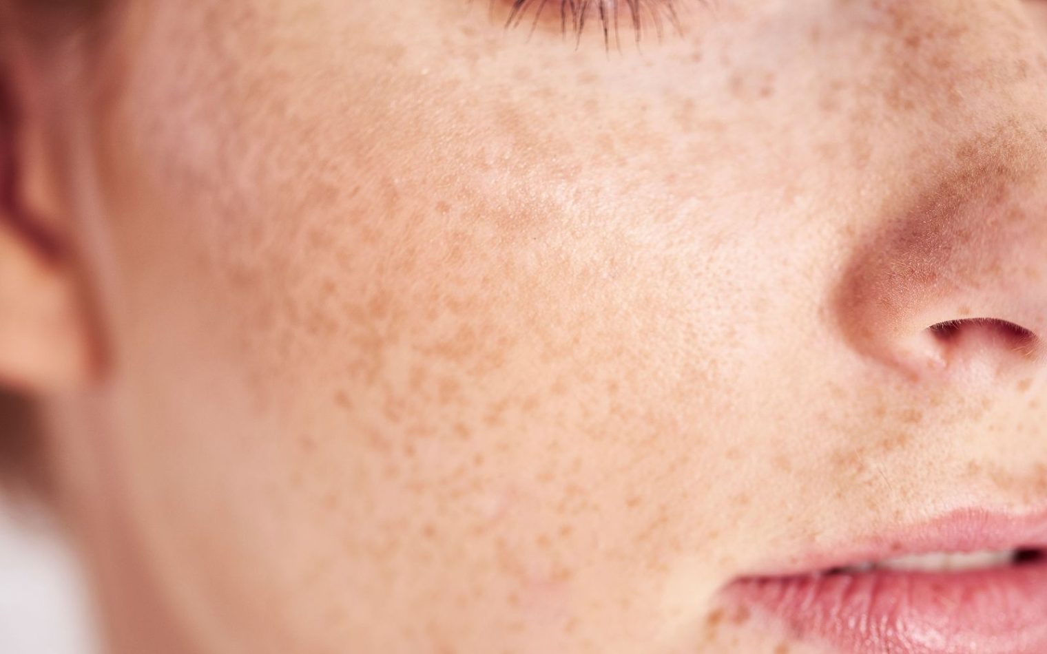 Freckles on facial skin