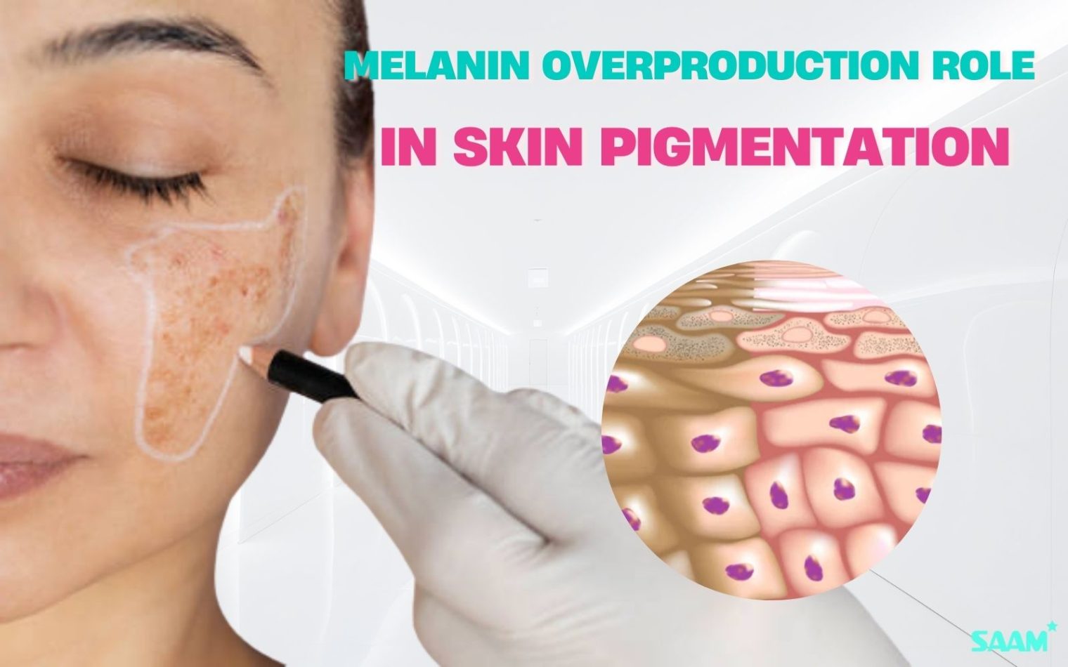 Melanin overproduction role in skin pigmentation