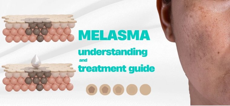 Melasma-Understanding And Treatment Guide