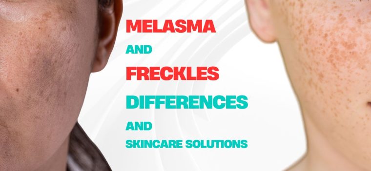 Melasma and Freckles - Differences And Effective Skincare Solutions