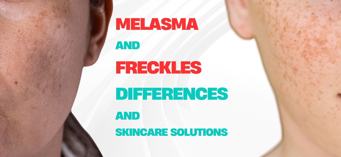 Melasma and Freckles - Differences And Effective Skincare Solutions