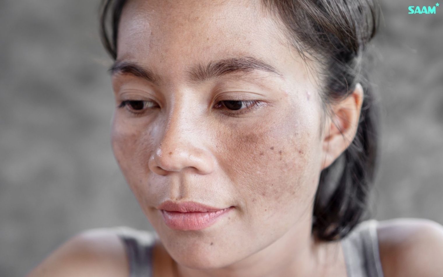 Melasma on facial skin
