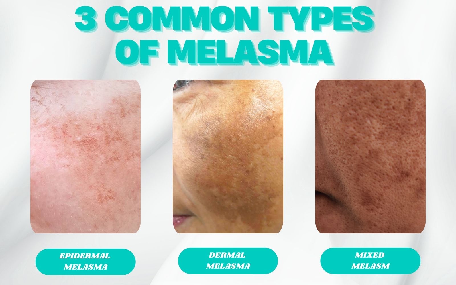 Three common types of melasma