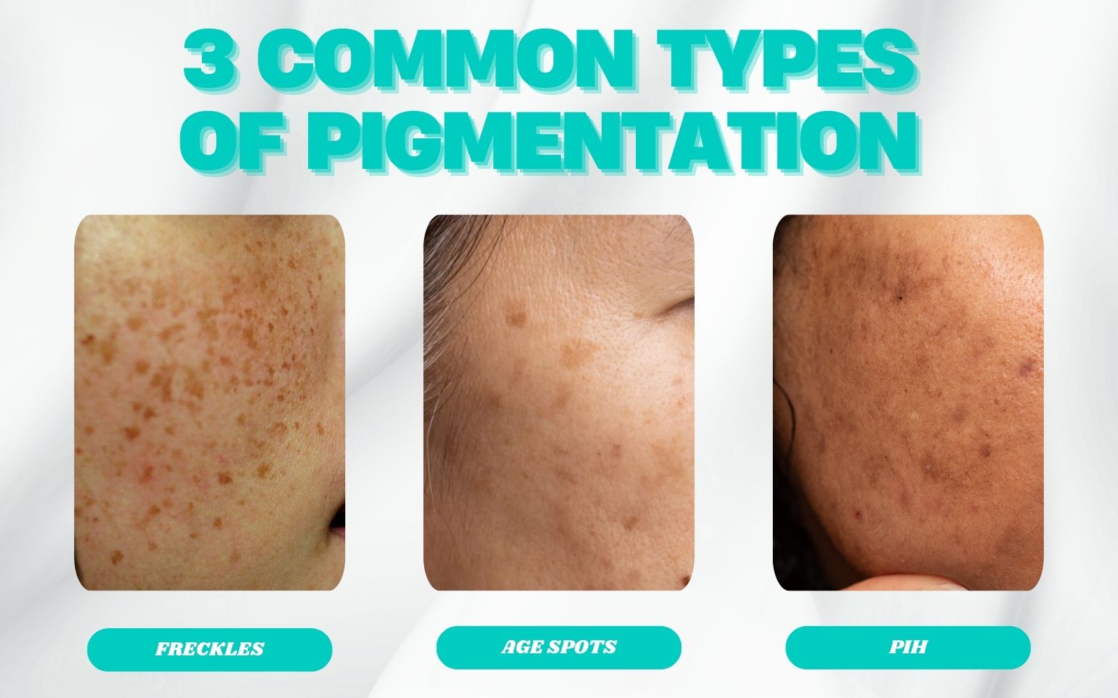 Three common types of pigmentation
