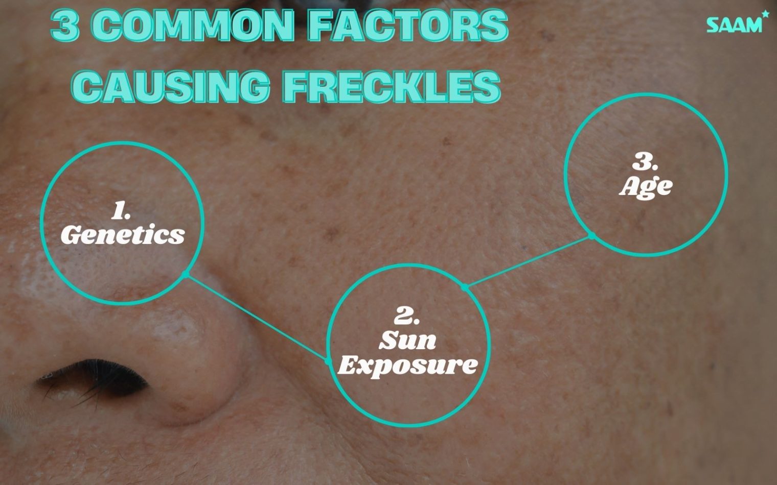 Understading melanin and freckles causes for better treatment