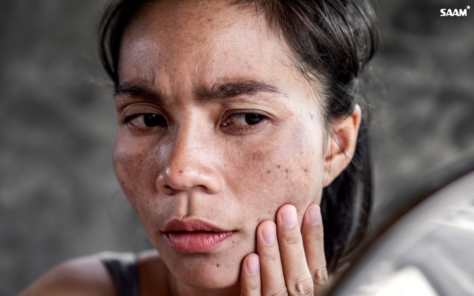 Understand what melasma is and what causes it