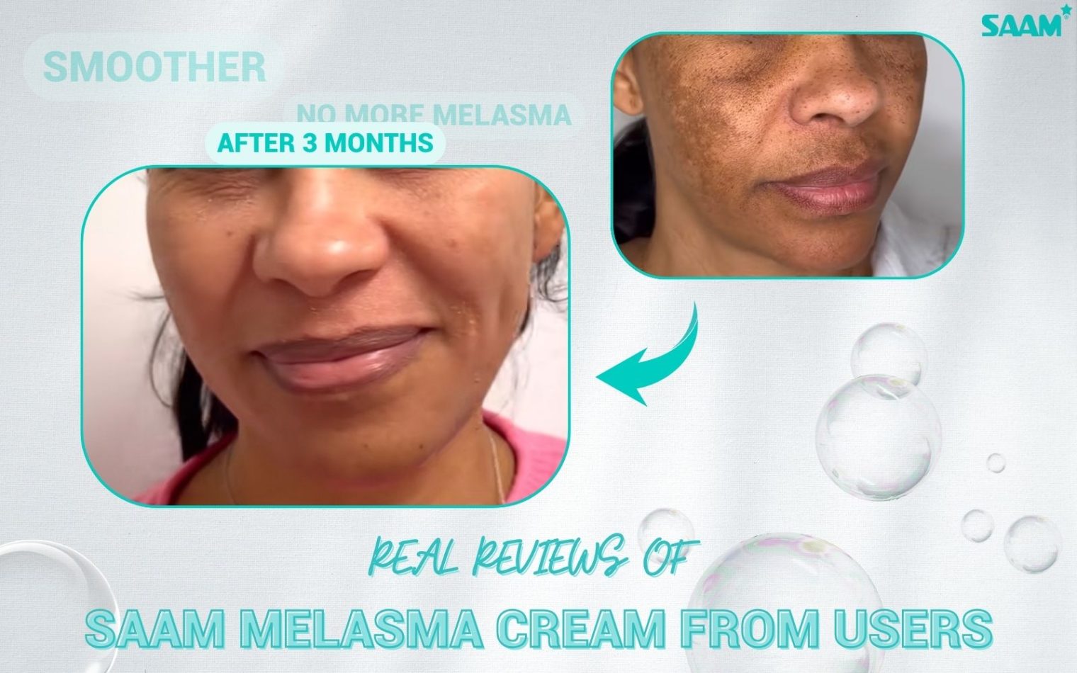 Real review of SAAM melasma cream from users