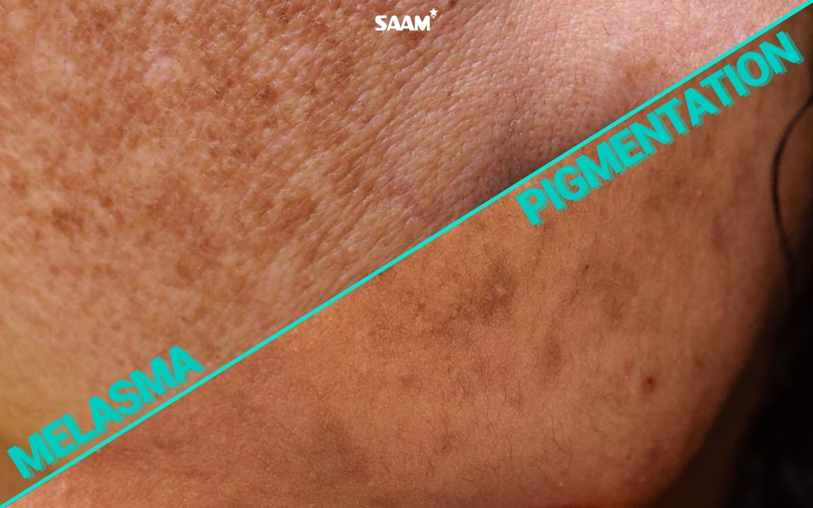 Differentiate between melasma and pigmentation (1)