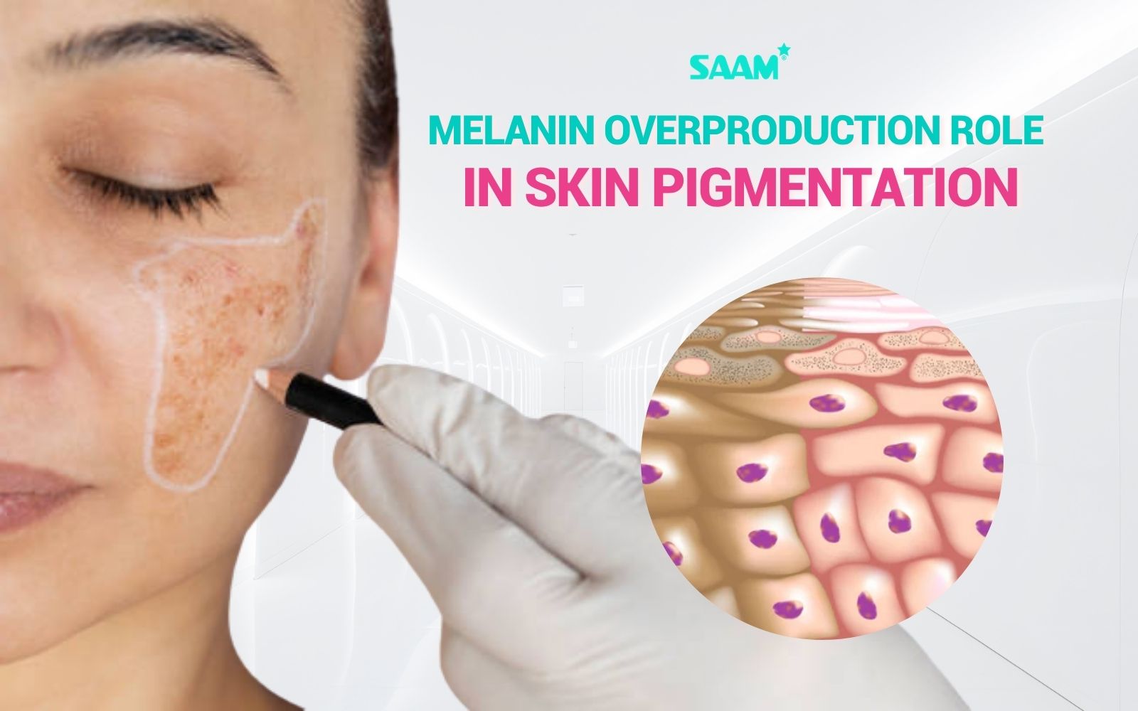 Melanin overproduction role in skin pigmentation (1)