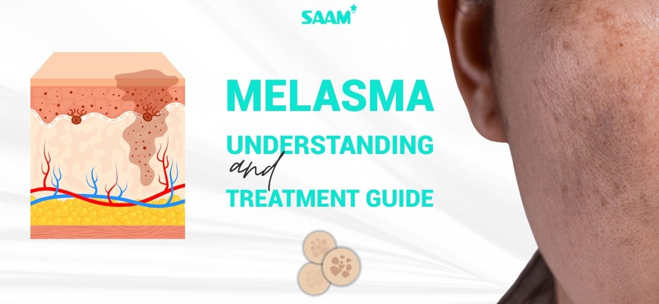 Melasma - Understanding And Treatment Guide