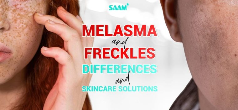 Melasma and Freckles - Differences And Effective Skincare Solutions (1)