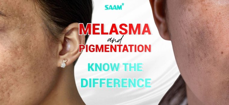 Melasma and Pigmentation - Know The Difference (1)