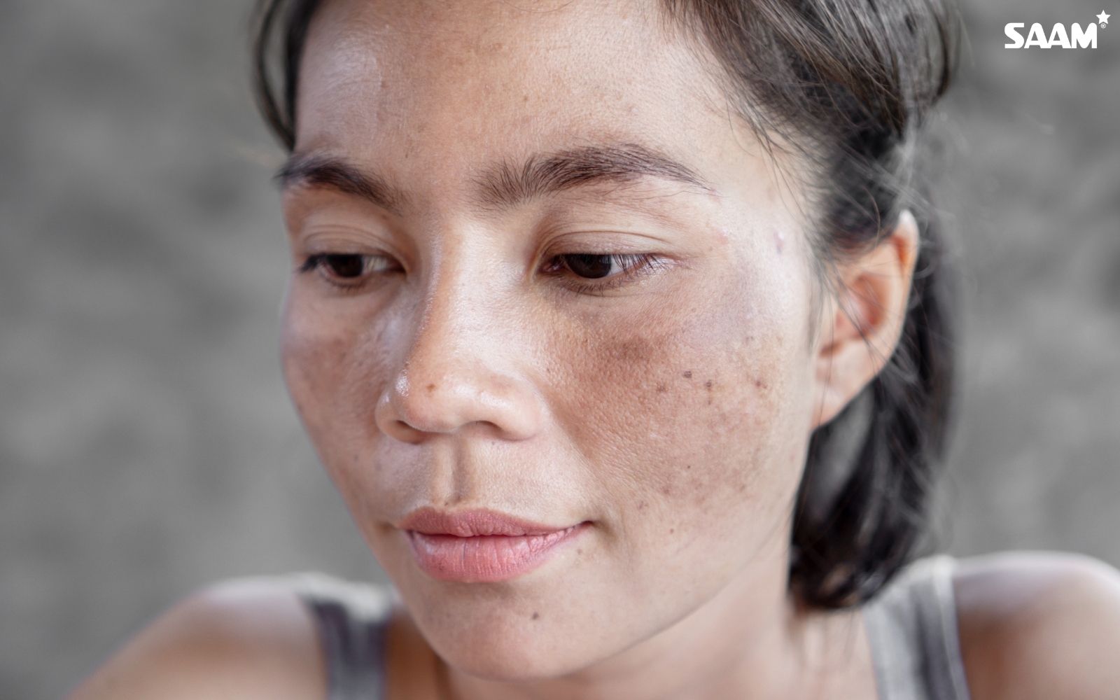 Melasma on facial skin (1)