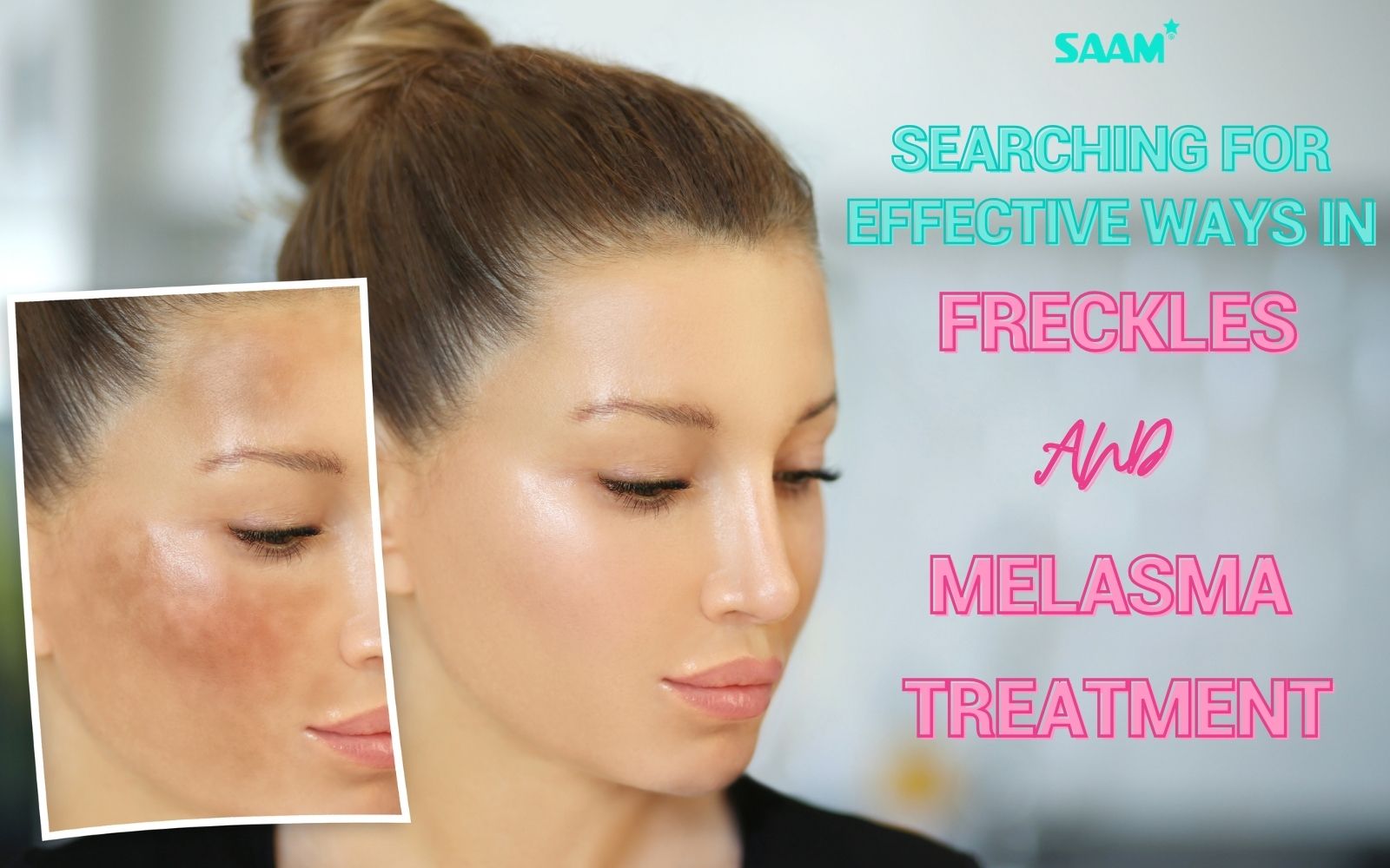 Searching for effective ways for freckles and melasma treatment (1)