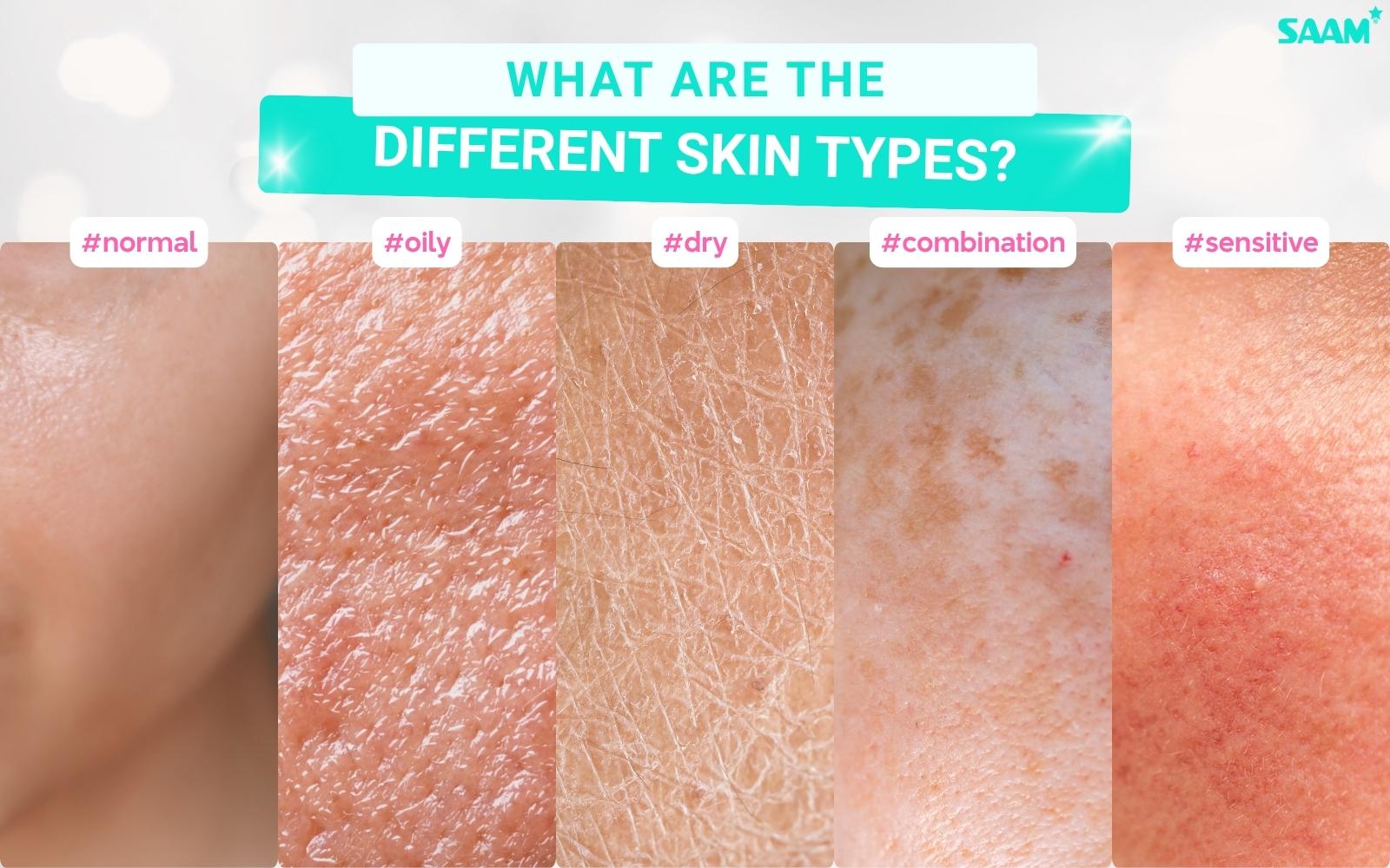 Skin is categorized into five main types