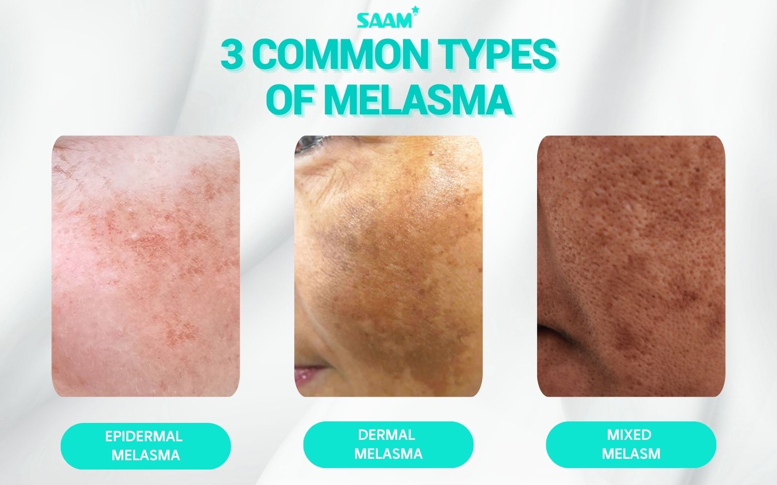 Three common types of melasma (1)
