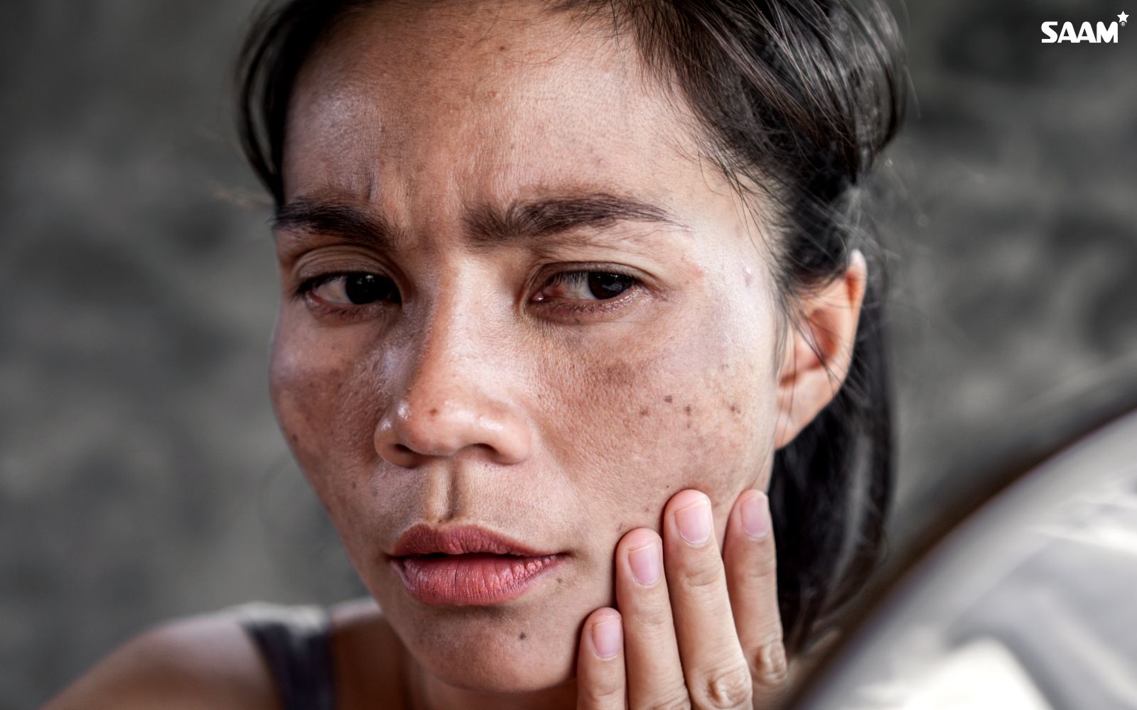 Understand what melasma is and what causes it (1)