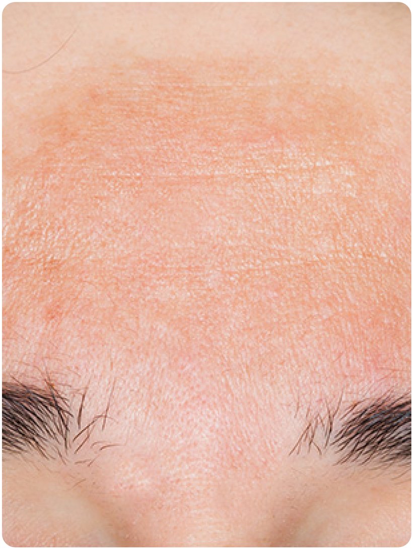Forehead