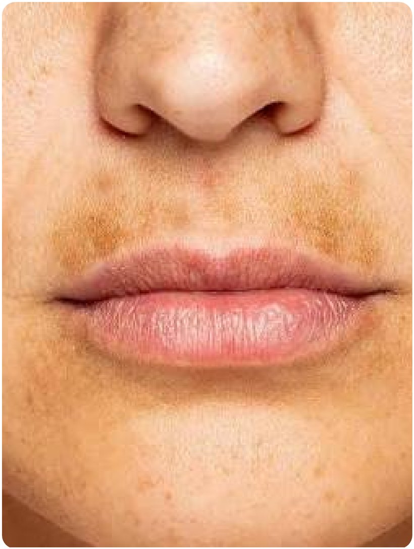 Upper lip