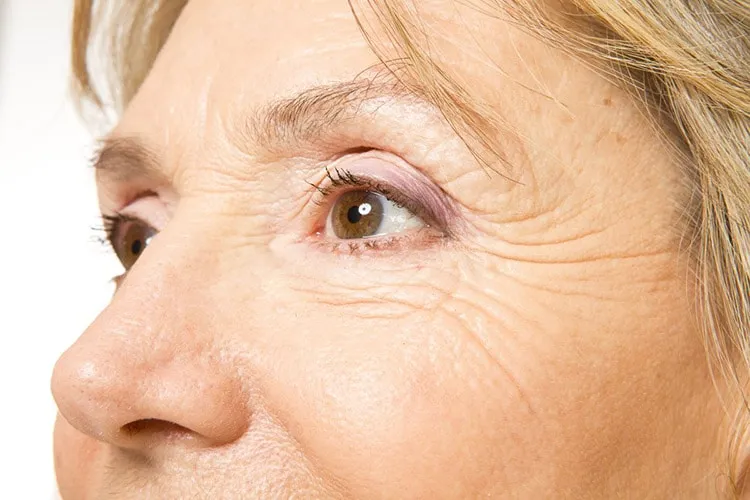 Fine lines & wrinkles