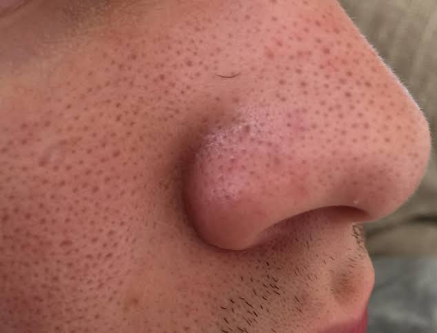 Nose
