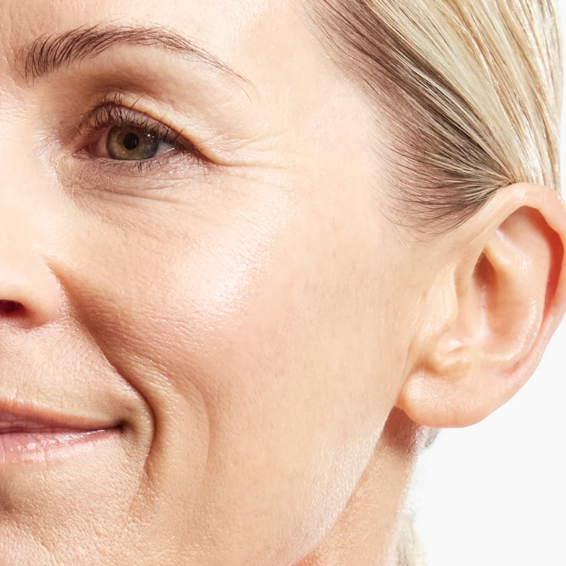 Smile lines & wrinkles