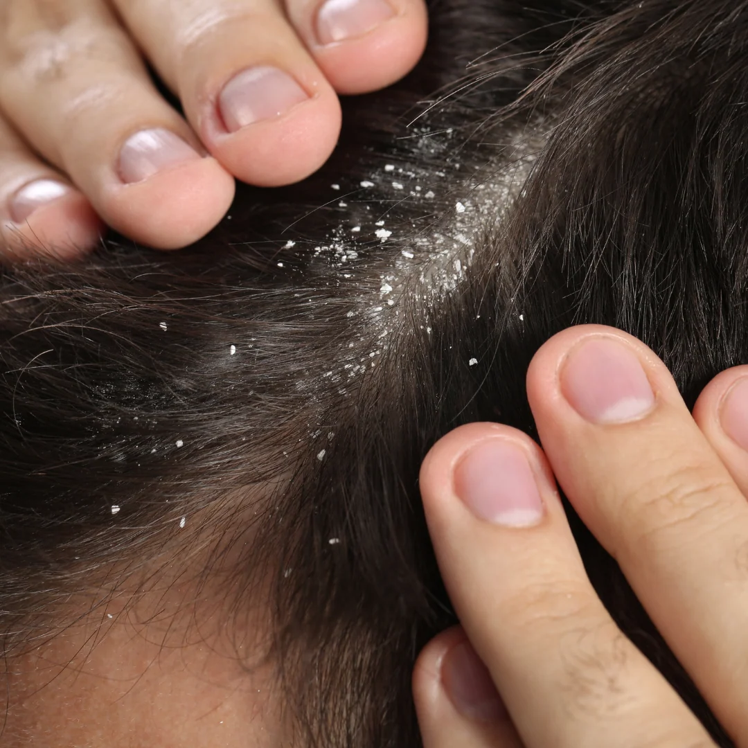 All Over Scalp